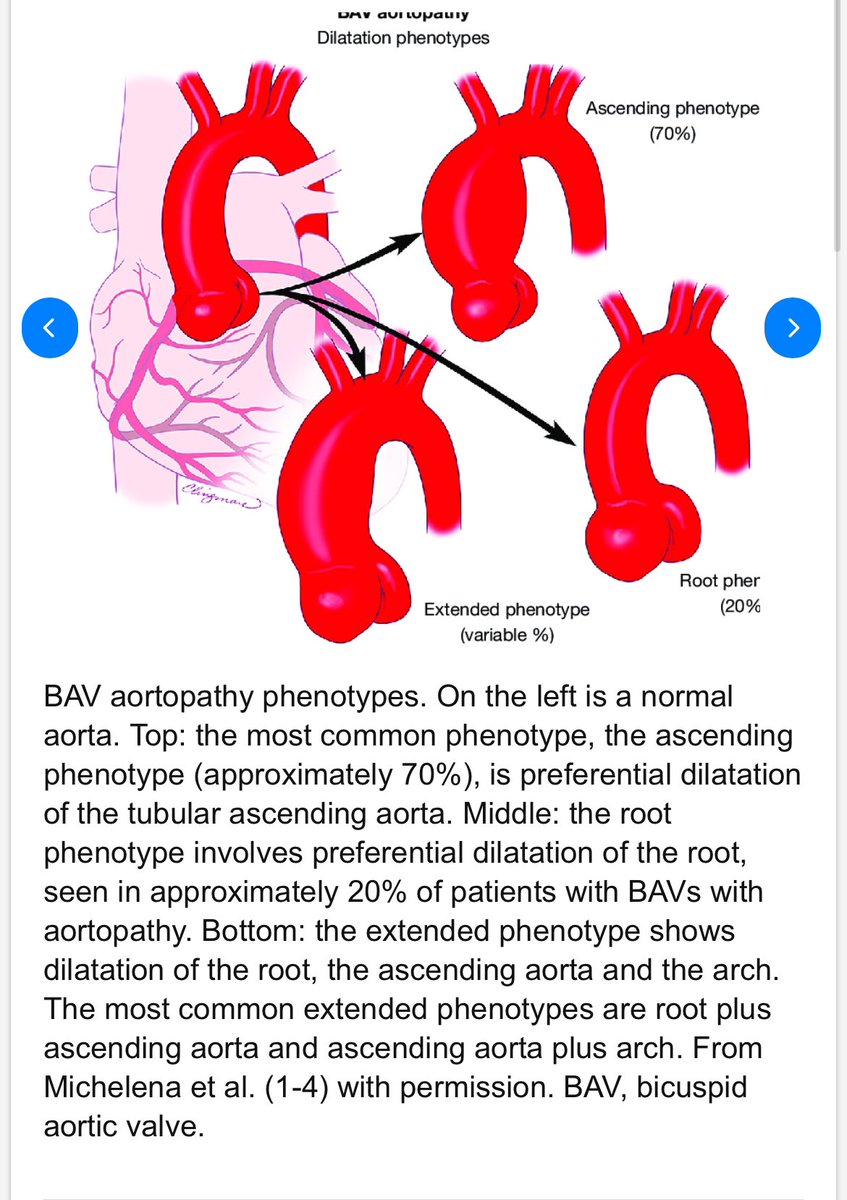 1/6
The 2024 ESC Guidelines on Peripheral Arterial and Aortic Diseases bring important updates on #BicuspidAorticValve (BAV). Here’s a quick summary for clinicians!