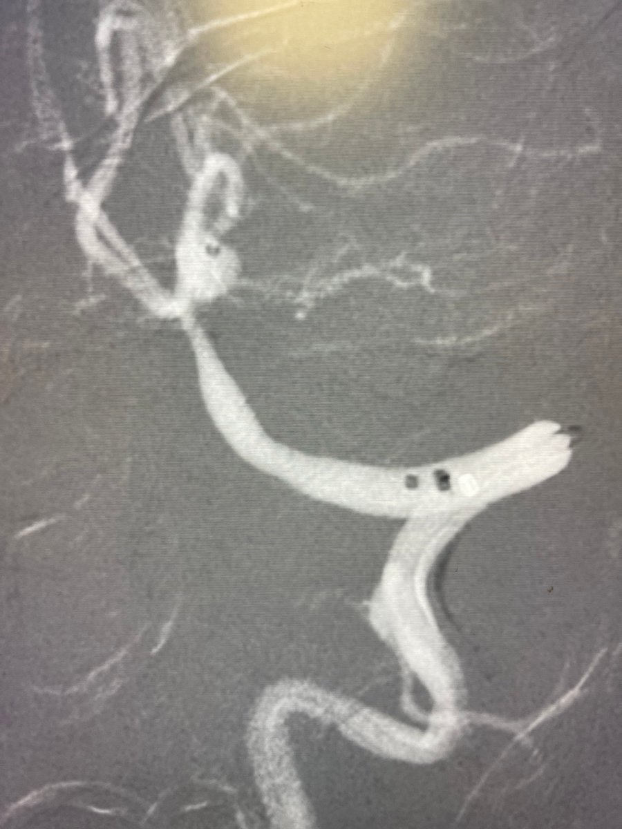 PenNeuro's tweet photo. US HCPs: 4 mm ruptured PICA aneurysm and challenging tortuosity. Access w/ #BMX96 and #MIDWAY 43 to support #ACCESS25 delivery of 2 #PC400 coils: 4x4 and 2x3 Extra Soft for 38% PD. Courtesy of Dr. Jahdav!
Rx only. For risk info: https://t.co/hzWEQEQmfZ Clinical results may vary https://t.co/E4lkRKhdVY