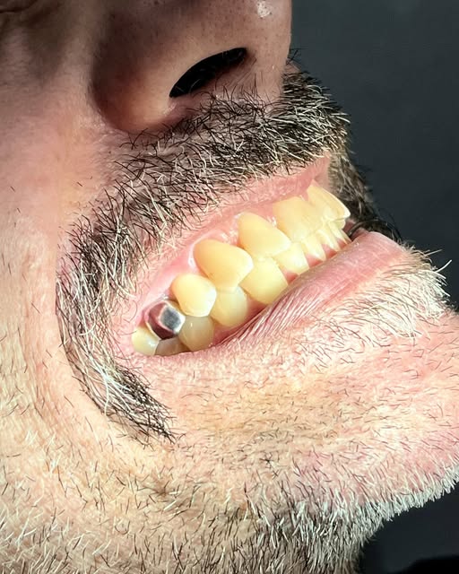 CIOSCSC's tweet photo. Sorriso único e cheio de estilo! 

Olha só o resultado desse procedimento incrível! 

Nosso paciente escolheu um toque especial para o sorriso, e o resultado ficou assim.

Aqui na CIOSC, transformamos sorrisos com técnica, personalização e muito estilo!

#SorrisoPersonalizado https://t.co/naNz6L4IkM