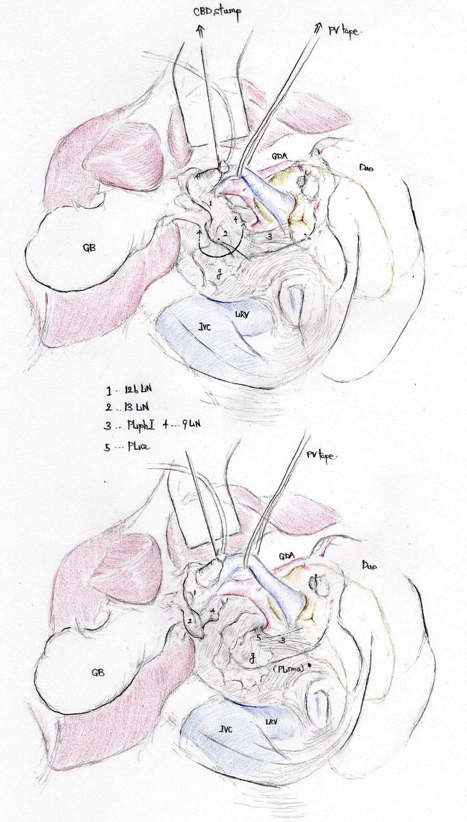 拡大左葉＋肝外胆管切除のオペレコの一部です
13郭清最後のシーン
剥がした13と12p 8p 9を一気に後腹膜から離断