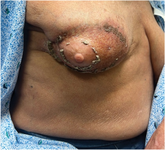 AJDP_Journal's tweet photo. #ClinicalPathologicChallenge
68YF with a slowly growing painful lesion involving the right breast with associated skin peeling.
Past M/H: early-stage invasive ductal carcinoma of right breast treated with lumpectomy and local radiation therapy
Dx? https://t.co/Ftzo8fpJ6a