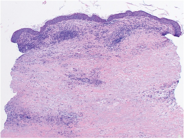 AJDP_Journal's tweet photo. #ClinicalPathologicChallenge
68YF with a slowly growing painful lesion involving the right breast with associated skin peeling.
Past M/H: early-stage invasive ductal carcinoma of right breast treated with lumpectomy and local radiation therapy
Dx? https://t.co/Ftzo8fpJ6a