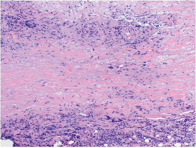 AJDP_Journal's tweet photo. #ClinicalPathologicChallenge
68YF with a slowly growing painful lesion involving the right breast with associated skin peeling.
Past M/H: early-stage invasive ductal carcinoma of right breast treated with lumpectomy and local radiation therapy
Dx? https://t.co/Ftzo8fpJ6a