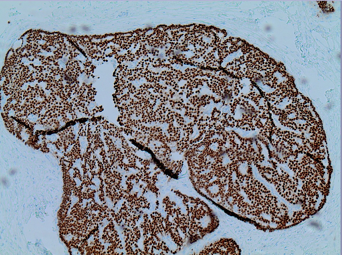 Hello #BreastPath friends! Spotted an interesting staining pattern—CK5/6 (3rd pic) is trying to tell me something in this intraductal proliferation, but I don’t speak its language. ER (last pic) is also in the mix. Awesome brains?