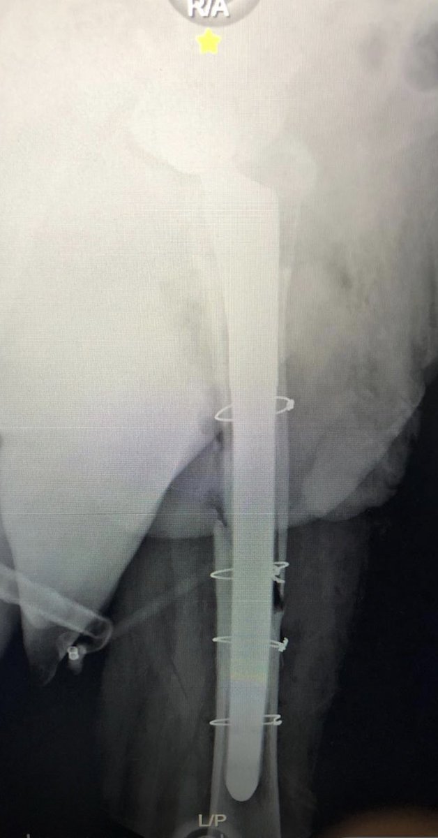 Danos Dios la prótesis de revisión de cadera nuestra de cada día, amén !!!