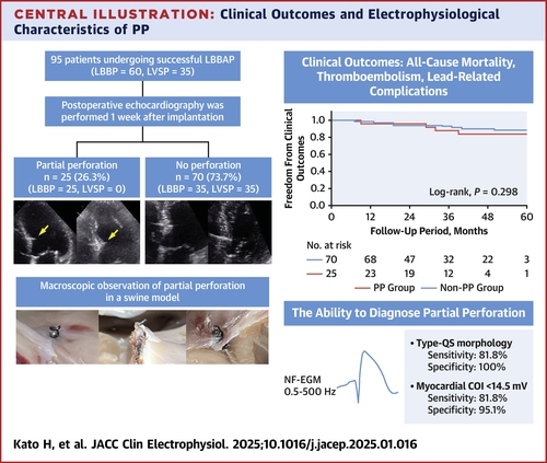 American College of Cardiology (@accintouch) on Twitter photo Partial perforations of the lead helix, a potential complication of left bundle branch area pacing, is not associated w/ a higher risk of adverse clinical outcomes, according to a new study published in #JACCCEP.
Read more: bit.ly/4htIter #cvEP <a href="/JACCJournals/">JACC Journals</a> Partial perforations of the lead helix, a potential complication of left bundle branch area pacing, is not associated w/ a higher risk of adverse clinical outcomes, according to a new study published in #JACCCEP.
Read more: bit.ly/4htIter #cvEP <a href="/JACCJournals/">JACC Journals</a>