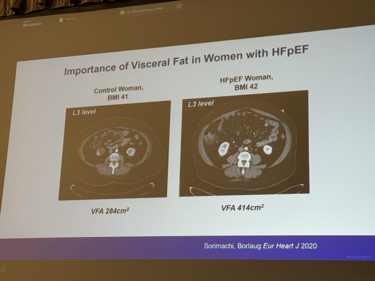 Eugenio Cingolani, MD (@eugeniocingolan) on Twitter photo Great talk at <a href="/HFpEFSummit/">HFpEF Summit</a> Dr. Barry Borlaug from <a href="/MayoClinic/">Mayo Clinic</a> via <a href="/Zoom/">Zoom</a> ➡️ Obesity phenotype in #HFpEF #Pathophysiology #Therapy <a href="/CMECedarsSinai/">CME Program at Cedars-Sinai</a> <a href="/SmidtHeart/">Smidt Heart Institute at Cedars-Sinai</a> <a href="/CedarsSinaiMed/">Cedars-Sinai Academic Medicine</a> Great talk at <a href="/HFpEFSummit/">HFpEF Summit</a> Dr. Barry Borlaug from <a href="/MayoClinic/">Mayo Clinic</a> via <a href="/Zoom/">Zoom</a> ➡️ Obesity phenotype in #HFpEF #Pathophysiology #Therapy <a href="/CMECedarsSinai/">CME Program at Cedars-Sinai</a> <a href="/SmidtHeart/">Smidt Heart Institute at Cedars-Sinai</a> <a href="/CedarsSinaiMed/">Cedars-Sinai Academic Medicine</a>