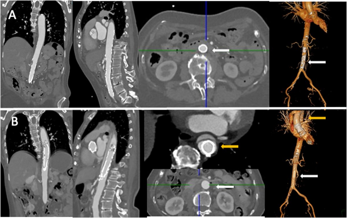 REC Publications (@revespcardiol) on Twitter photo Detachment of a severely calcified atheroma during TAVI. #REC #AheadOfPrint @martahb5 <a href="/RuizNodarJM/">Juan Miguel Ruiz Nodar</a> revespcardiol.org/en-detachment-… Detachment of a severely calcified atheroma during TAVI. #REC #AheadOfPrint @martahb5 <a href="/RuizNodarJM/">Juan Miguel Ruiz Nodar</a> revespcardiol.org/en-detachment-…