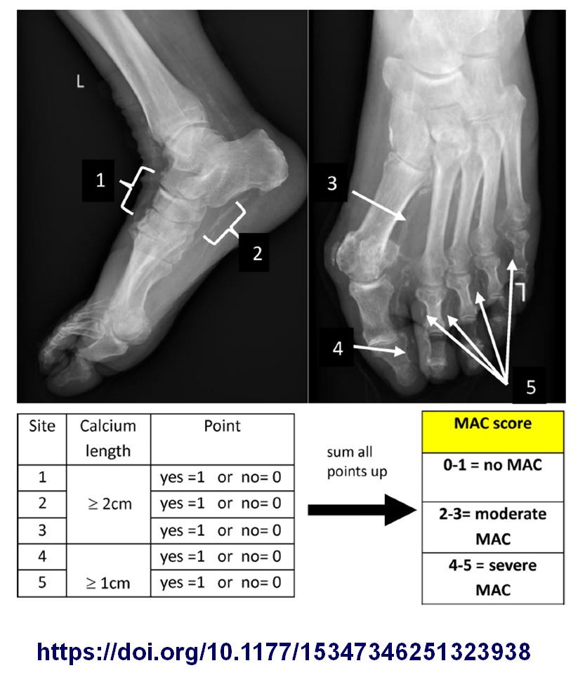 La calcificación de la capa media de las arterias distales del paciente con pie diabético ulcerado, se asocia con mayor severidad de las arterias distales, peores resultados tras angioplastia, menor tasa de cicatrización y mas amputaciones. #piediabético
doi.org/10.1177/153473…