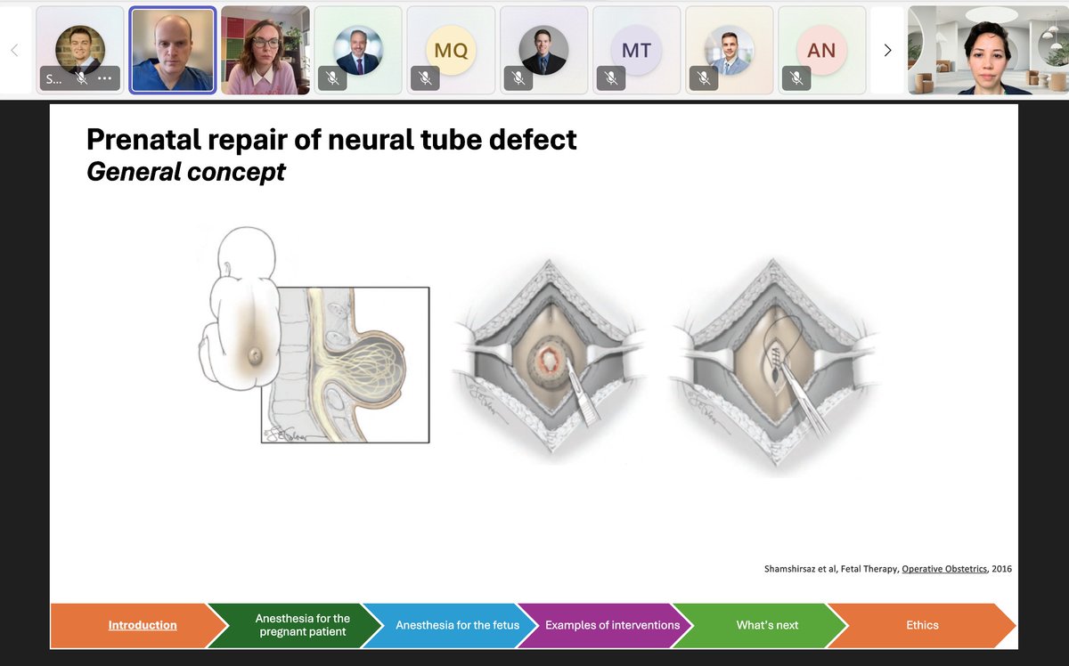 🔬📢 Exciting insights from Drs. Caitlin Sutton &amp; David Berman on anesthesia updates for open fetal surgery! Covering maternal &amp; fetal considerations, interventions, and what's next for this evolving field. #OBAnes #Anesthesia