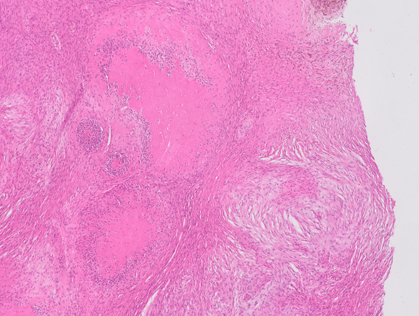 FelipePatologia's tweet photo. Giant collagen rosettes in a classic Low grade fibromyxoid sarcoma

#USCAP25 is coming! https://t.co/WAtYA8WNFQ