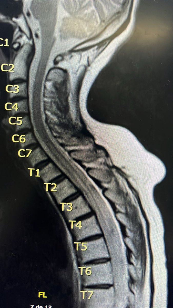 No problem with MS,...NMO is a progressive disease in some pts...