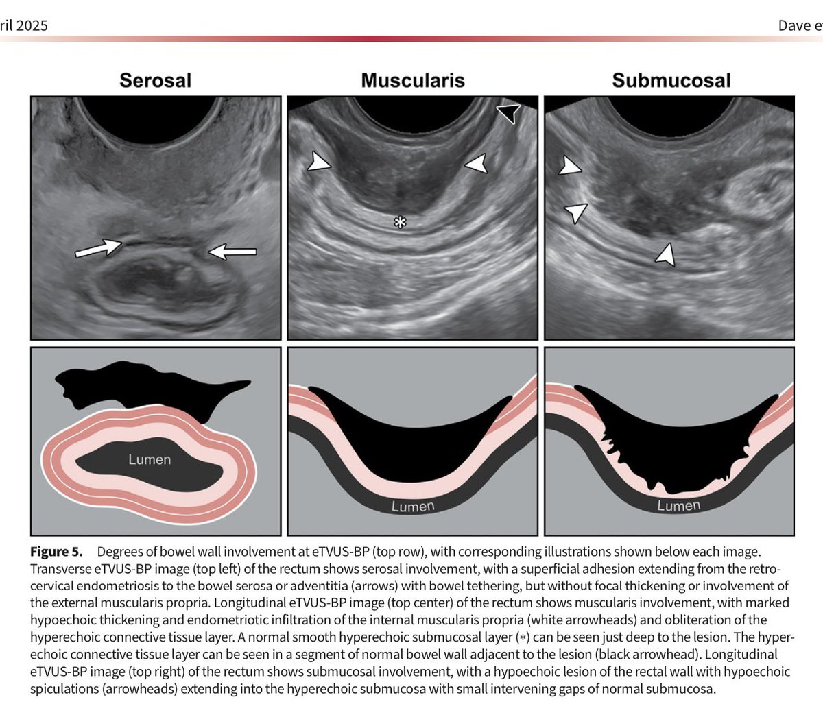 luciana@chamie.com.br (@lucianachamiec1) on Twitter photo It is with great satisfaction that I share with you this beautiful new work on the imaging diagnosis of bowel endometriosis using dedicated US and MRI protocols, carried out by a team of experts from the <a href="/SARpelvicDFPs/">Pelvic Imaging DFPs of SAR</a> led by @haataldave and @ASBEpic <a href="/RadioGraphics/">RadioGraphics</a> <a href="/RSNA/">RSNA</a> It is with great satisfaction that I share with you this beautiful new work on the imaging diagnosis of bowel endometriosis using dedicated US and MRI protocols, carried out by a team of experts from the <a href="/SARpelvicDFPs/">Pelvic Imaging DFPs of SAR</a> led by @haataldave and @ASBEpic <a href="/RadioGraphics/">RadioGraphics</a> <a href="/RSNA/">RSNA</a>