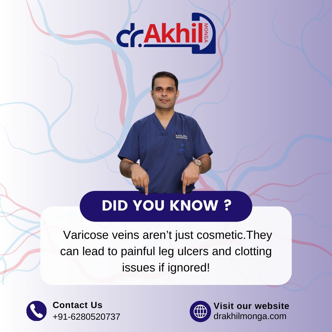 Varicose veins are more than a cosmetic issue; untreated, they may lead to ulcers and clots. Early treatment is key.

👉 Don’t wait—consult today!
🌐 Visit: drakhilmonga.com
📞 Call: +91-6280520737
.
.
#VaricoseVeins #VeinHealth #LegPain #HealthyLegs #VascularCare