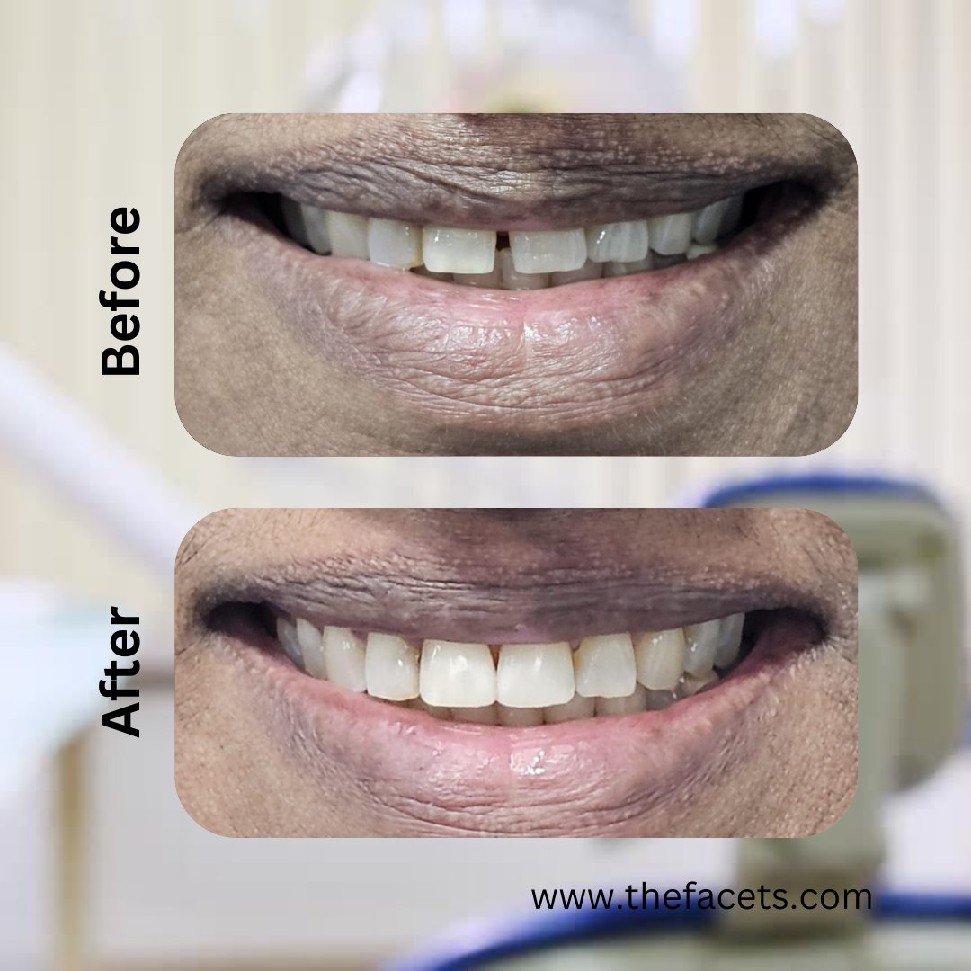 Get your teeth gap filled with composite bonding/ filling from Facets Cosmetic and Restorative Dental Kochi, Kerala. One of the best dental clinic in Kochi with 25 years of excellence and Trust.

Call/ Whatsapp: +91 90 20 160 160
Website: thefacets.com