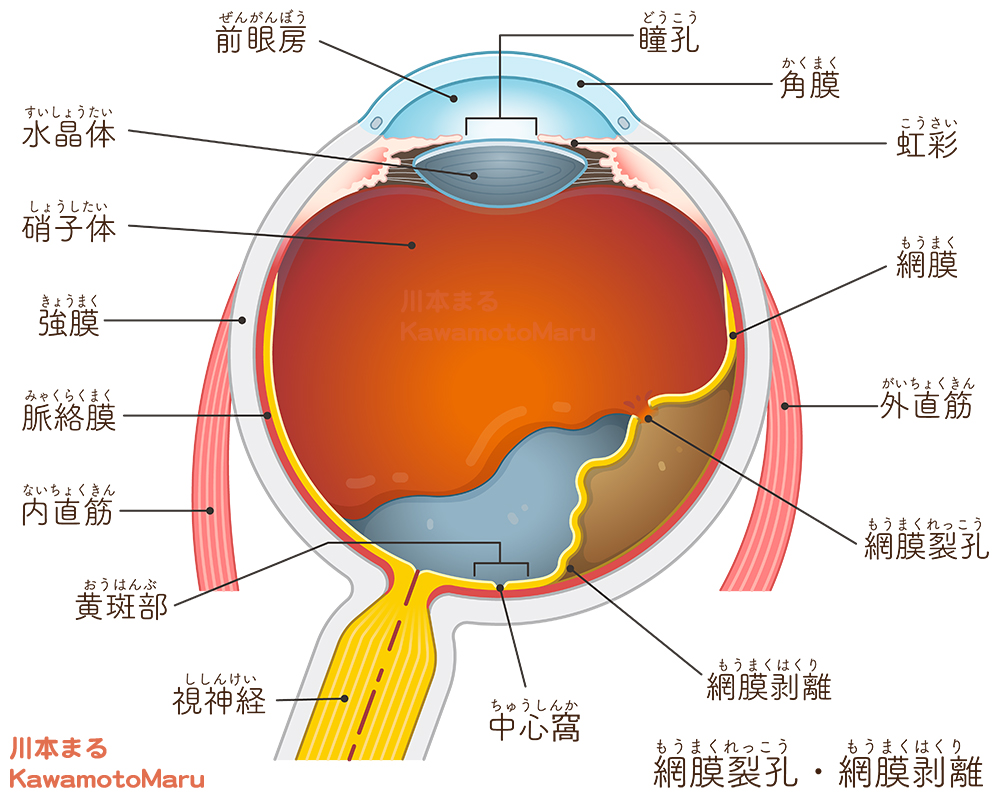 黄斑浮腫のイラストと、網膜剥離、網膜裂孔のイラストです(2023年)