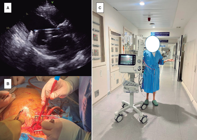 REC Publications (@revespcardiol) on Twitter photo Impella de alto flujo: una estrategia efectiva en el soporte mecánico del shock cardiogénico como puente al trasplante. #RECintervcardiol #AheadOfPrint <a href="/ignamatsant/">Ignacio J. Amat</a> @javier_tobar
🔗recintervcardiol.org/es/cartas-cien… Impella de alto flujo: una estrategia efectiva en el soporte mecánico del shock cardiogénico como puente al trasplante. #RECintervcardiol #AheadOfPrint <a href="/ignamatsant/">Ignacio J. Amat</a> @javier_tobar
🔗recintervcardiol.org/es/cartas-cien…