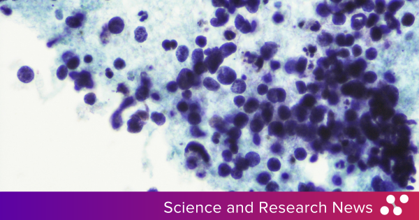 LifeNoble's tweet photo. An AI-powered prognostic tool for non-small cell lung cancer (NSCLC) has received FDA Breakthrough Device Designation, marking a step forward in precision oncology. Read the details: https://t.co/XO1iiY4Rer

#oncology #lungcancer #lifesciences https://t.co/tle1AMs9wT