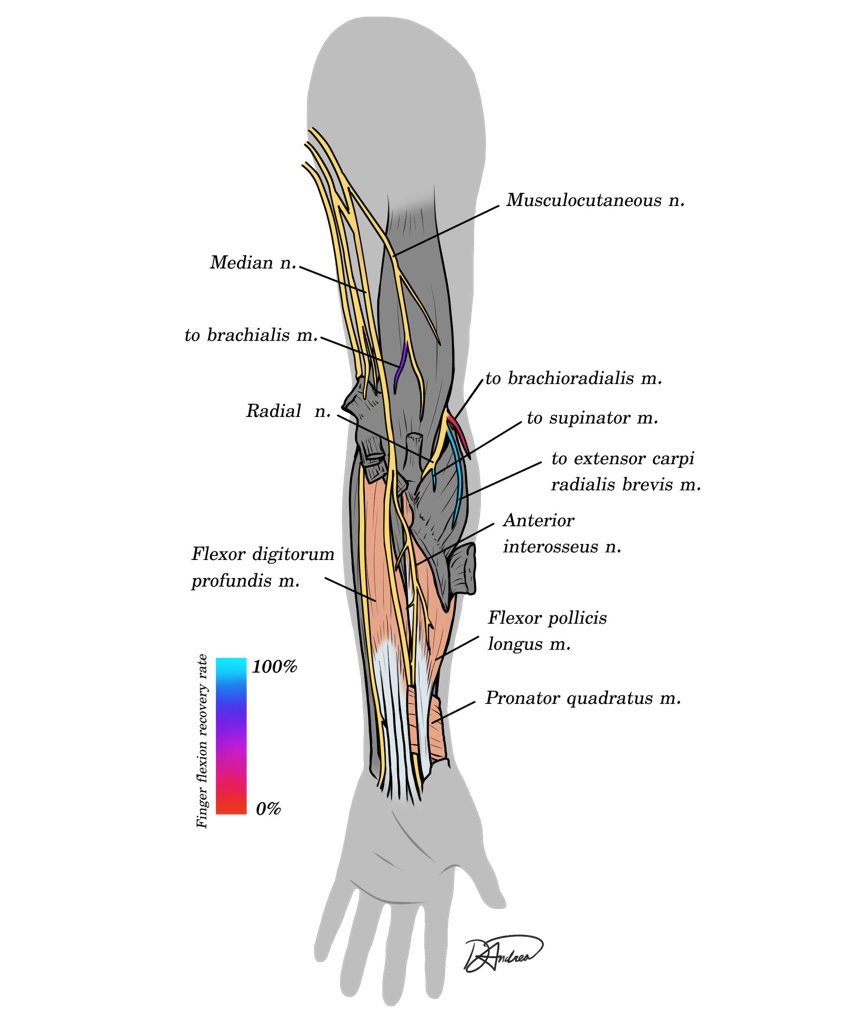 Spinal Cord Journal (@journalsci) on Twitter photo This review synthesizes the outcomes of finger and thumb flexion after various nerve transfers to the anterior interosseous nerve. <a href="/Pavlostex/">Pavlos Texakalidis</a>
nature.com/articles/s4139… This review synthesizes the outcomes of finger and thumb flexion after various nerve transfers to the anterior interosseous nerve. <a href="/Pavlostex/">Pavlos Texakalidis</a>
nature.com/articles/s4139…