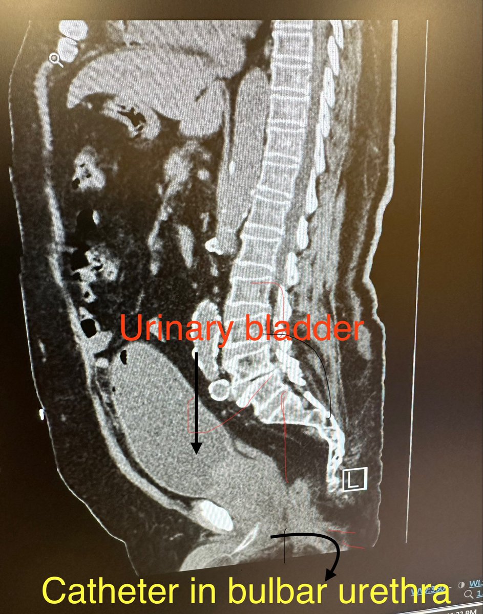 While we chase advanced technologies, malpositioned catheter still an issue