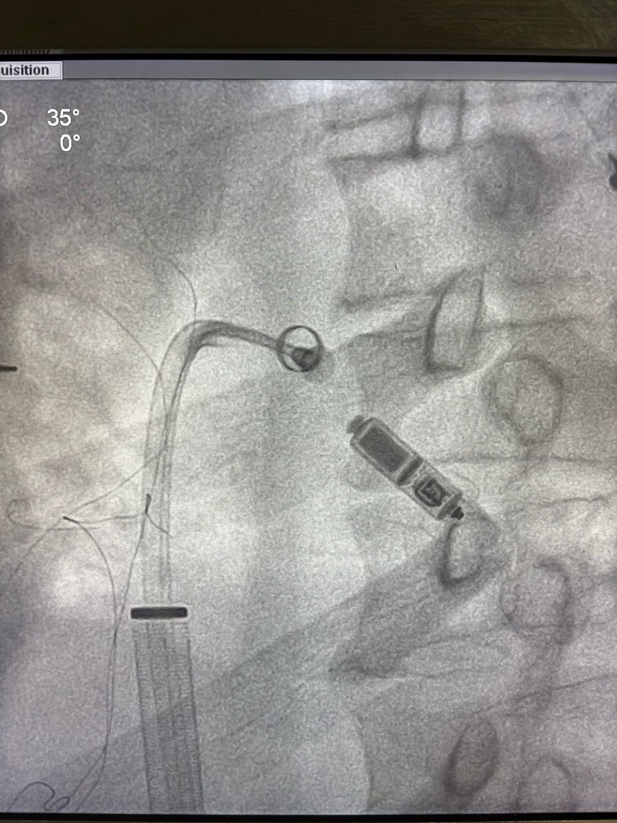 Kıvanç YALIN (@yalinkivanc) on Twitter photo The first leadless pacemaker implantation at our university has been successfully performed! Many thanks to Prof. Dr. Ahmet Kaya Bilge and Prof. Dr. Fethi Kılıçaslan for their support in this milestone. <a href="/iu_cerrahpasa/">İstanbul Üniversitesi-Cerrahpaşa - #eniyiolmakiçin</a> <a href="/cerrahpasatipf/">İÜC. Cerrahpaşa Tıp Fakültesi</a> The first leadless pacemaker implantation at our university has been successfully performed! Many thanks to Prof. Dr. Ahmet Kaya Bilge and Prof. Dr. Fethi Kılıçaslan for their support in this milestone. <a href="/iu_cerrahpasa/">İstanbul Üniversitesi-Cerrahpaşa - #eniyiolmakiçin</a> <a href="/cerrahpasatipf/">İÜC. Cerrahpaşa Tıp Fakültesi</a>