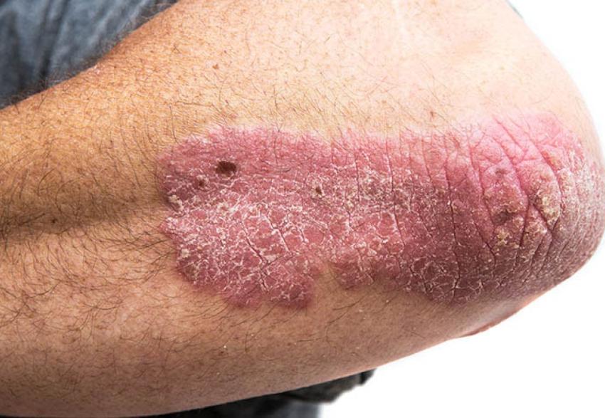 infosalut's tweet photo. #PublicaSalutIB 💻💊 @bielmercadal1 farmacéutico de @asmen_ibsalut ha participado en el estudio TELEPROM para mejorar la atención y la CVRS en psoriasis moderada-grave https://t.co/B4Bs2OfKX4 @farupeib https://t.co/wequV3K0CY
#TELEPROM #psoriasi #farmàcia #telefarmàcia https://t.co/BiC5psINJA
