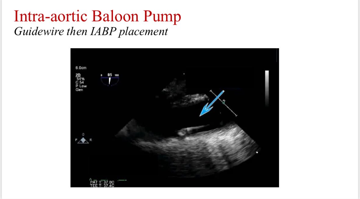 Juan G. Ripoll, MD (@juangripoll1) on Twitter photo Outstanding lecture to the Harvard-Mayo Critical Care Echo Consortium by my colleague Dr. <a href="/EchoSoliman/">Hatem Soliman, FRCP, FEACVI, FASE, FHEA</a> ! 🫀 Always a pleasure having you join our lectures <a href="/MayoAnesthesia/">Mayo Clinic Department of Anesthesiology</a> <a href="/MGHanesthesia/">Mass General Anesthesia</a> Outstanding lecture to the Harvard-Mayo Critical Care Echo Consortium by my colleague Dr. <a href="/EchoSoliman/">Hatem Soliman, FRCP, FEACVI, FASE, FHEA</a> ! 🫀 Always a pleasure having you join our lectures <a href="/MayoAnesthesia/">Mayo Clinic Department of Anesthesiology</a> <a href="/MGHanesthesia/">Mass General Anesthesia</a>
