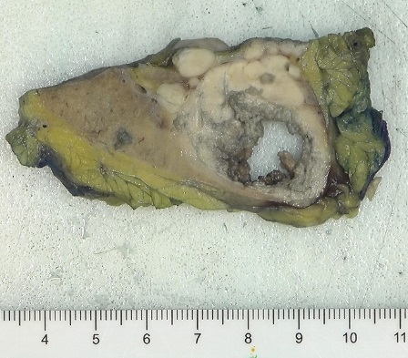 slusagar's tweet image. #GUpath #grosspath 🔬correlate in this radical nephrectomy 

smaller, irregular adjacent nodules from main tumor as concerning for pT3a vascular invasion (esp for clear cell RCC, as shown here)