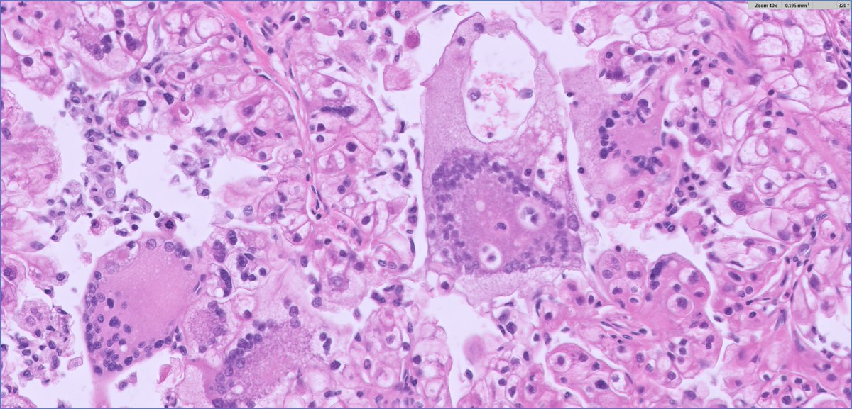 recent 😍example of clear cell RCC with syncytial-type multinucleated giant cells  uncommon

✔️assoc w/poor outcome even if lacking other poor histologic parameters

🔬 emperipolesis quite frequent!

⏬cont'd⏬