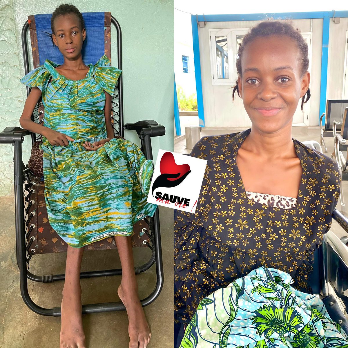 cherifmohamed_'s tweet photo. Deux jours séparent ces deux photos…☺️

Heureux de voir le sourire de notre Gueye. Le combat continue : suivi médical intensif, kinésithérapie, compléments alimentaires… Dans un mois, tu marcheras, je le dis avec foi 🙏

Seigneur, étends ta main 🙏 https://t.co/0K0P7wcMGI