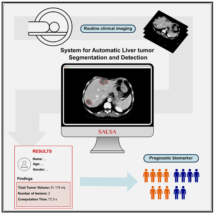 DailyHealthcareAI (@aipulserx) on Twitter photo What if AI could automatically detect and outline liver tumors from CT scans, potentially revolutionizing cancer detection and treatment planning?<a href="/CellRepMed/">Cell Reports Medicine</a> <a href="/radiomicsVHIO/">Radiomics Group</a>
"A CT-based deep learning-driven tool for automatic
liver tumor detection and delineation in patients What if AI could automatically detect and outline liver tumors from CT scans, potentially revolutionizing cancer detection and treatment planning?<a href="/CellRepMed/">Cell Reports Medicine</a> <a href="/radiomicsVHIO/">Radiomics Group</a>
"A CT-based deep learning-driven tool for automatic
liver tumor detection and delineation in patients