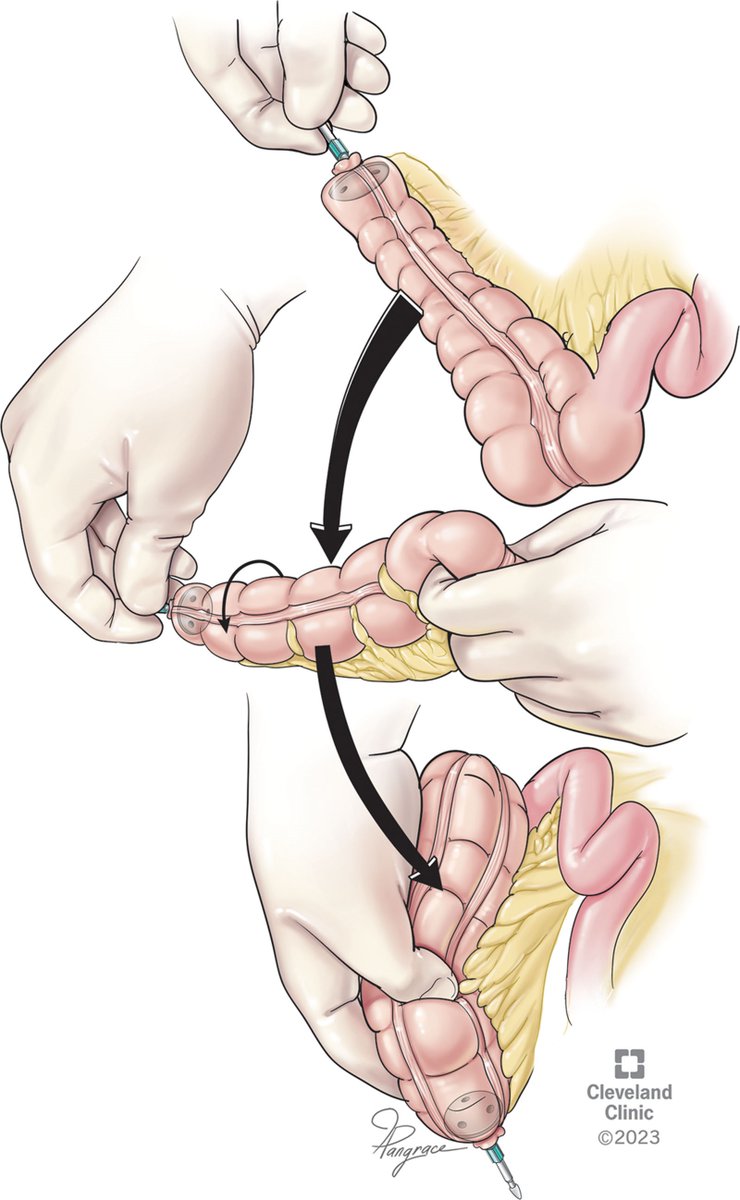 DCRjournal (@dcrjournal) on Twitter photo Large single institution series of pts undergoing the Deloyers technique for restoration of bowel continuity. Read more in this month's #DCRJournal: bit.ly/4bBp7mf
<a href="/lfsobrado/">Lucas Sobrado</a> <a href="/drtracyhull/">Tracy Hull</a> <a href="/ClevelandClinic/">Cleveland Clinic</a> Large single institution series of pts undergoing the Deloyers technique for restoration of bowel continuity. Read more in this month's #DCRJournal: bit.ly/4bBp7mf
<a href="/lfsobrado/">Lucas Sobrado</a> <a href="/drtracyhull/">Tracy Hull</a> <a href="/ClevelandClinic/">Cleveland Clinic</a>