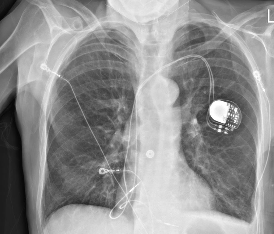 Dual-chamber pacemaker implanted elsewhere long ago for heart block. Atrial lead senses well, but doesn't capture at maximum output. Where is this lead? #EPeeps #Cardiology