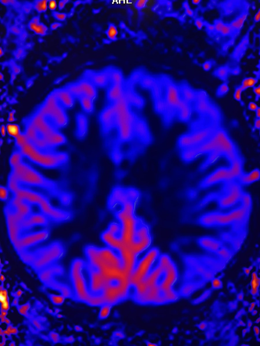 Is that difference in perfusion real or artifactual? Am I missing a malformation, though the T1 and FLAIR are unrevealing? If it is an artefact, what’s the physics behind it?

Do these questions haunt you too?

If you are a part of the same stream, join the #IPNTN bandwagon this