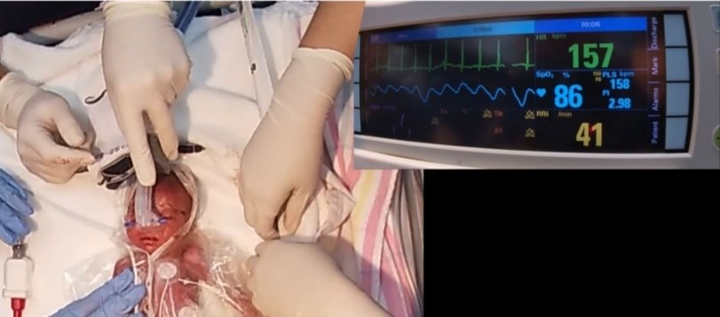 Atul Malhotra (@atul_monash) on Twitter photo Preprint (not peer-reviewed) of the FONDUE trial paper led by Drs Blank & <a href="/calumtheroberts/">Calum Roberts</a> out now:
Face or Nasal Mask Device Use for Initial Resuscitation in Extremely and Very Premature Infants (FONDUE): A Single-Centre, Randomised, Superiority Trial
papers.ssrn.com/sol3/papers.cf… Preprint (not peer-reviewed) of the FONDUE trial paper led by Drs Blank & <a href="/calumtheroberts/">Calum Roberts</a> out now:
Face or Nasal Mask Device Use for Initial Resuscitation in Extremely and Very Premature Infants (FONDUE): A Single-Centre, Randomised, Superiority Trial
papers.ssrn.com/sol3/papers.cf…