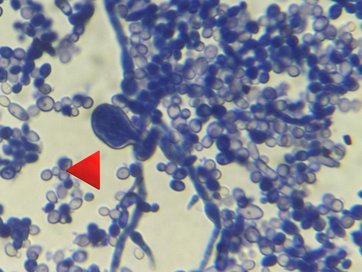 Hewxi_'s tweet photo. Found what appears to be a fungi structure called sporangiospore surrounded by yeast in methylene blue stain (figure 1) from a cultured sample of bread (figure 2)

Idk looked cool, thought I'd share :D https://t.co/Zqesc5l3gg