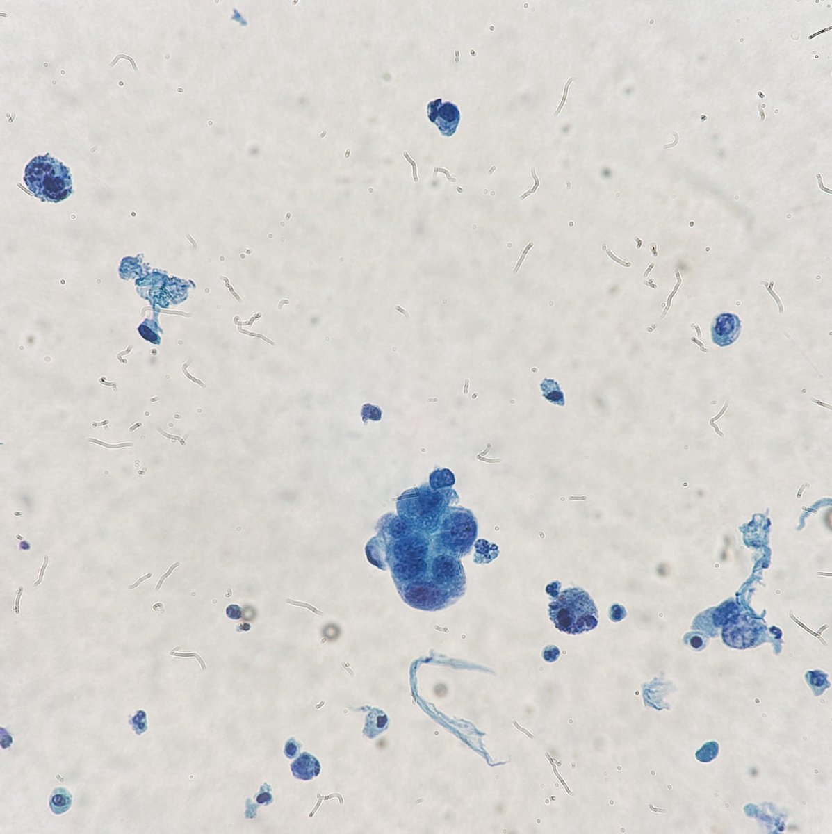 Path4People's tweet image. Congrats to everyone who found out where they will do residency!!!! 👏🏼 

55 year old Male smoker with Gross Hematuria

Urine Cystoscopy: 2 cm erythematous mass seen. 

Dx?

#cyto #pap #pathx #pathology #pathmed