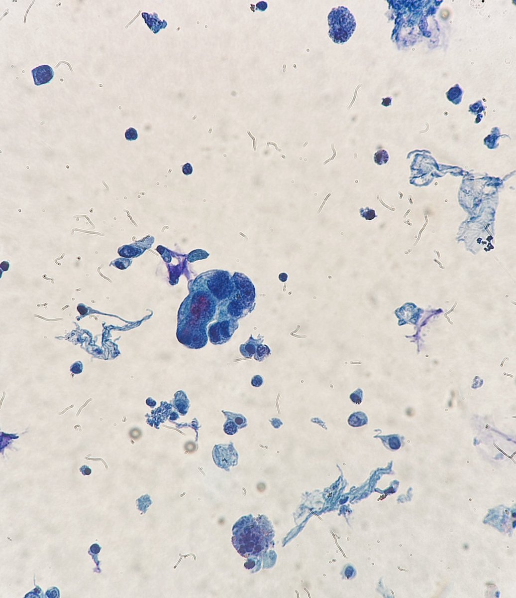 Path4People's tweet image. Congrats to everyone who found out where they will do residency!!!! 👏🏼 

55 year old Male smoker with Gross Hematuria

Urine Cystoscopy: 2 cm erythematous mass seen. 

Dx?

#cyto #pap #pathx #pathology #pathmed
