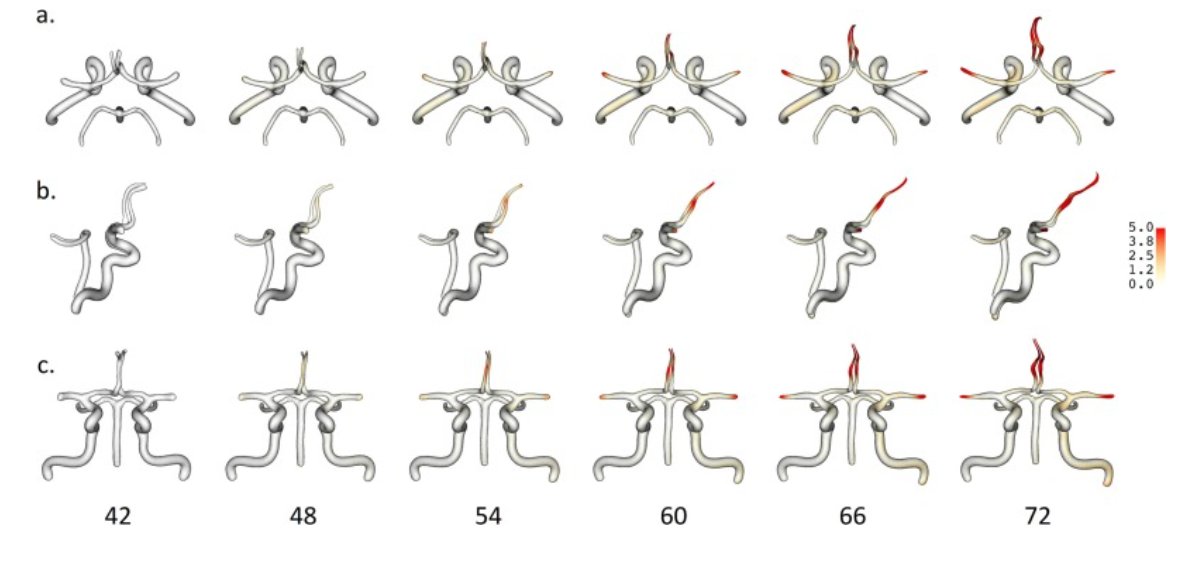 eic_nic's tweet image. Out now: A new longitudinal cerebrovascular atlas based on shape analyses
sciencedirect.com/science/articl…
Chien, Vinuela, et al