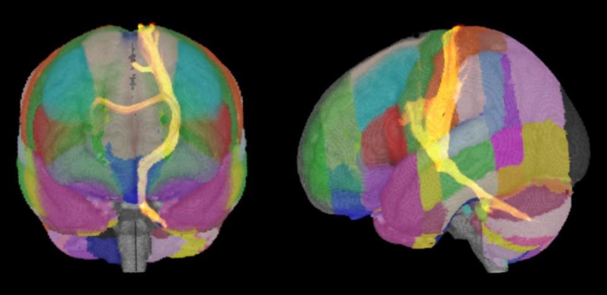 eic_nic's tweet image. Connectivity markers of DBS efficacy for essential tremor
Grimm et al
sciencedirect.com/science/articl…
Sensorimotor connectivity is of highest relevance for complete tremor suppression.