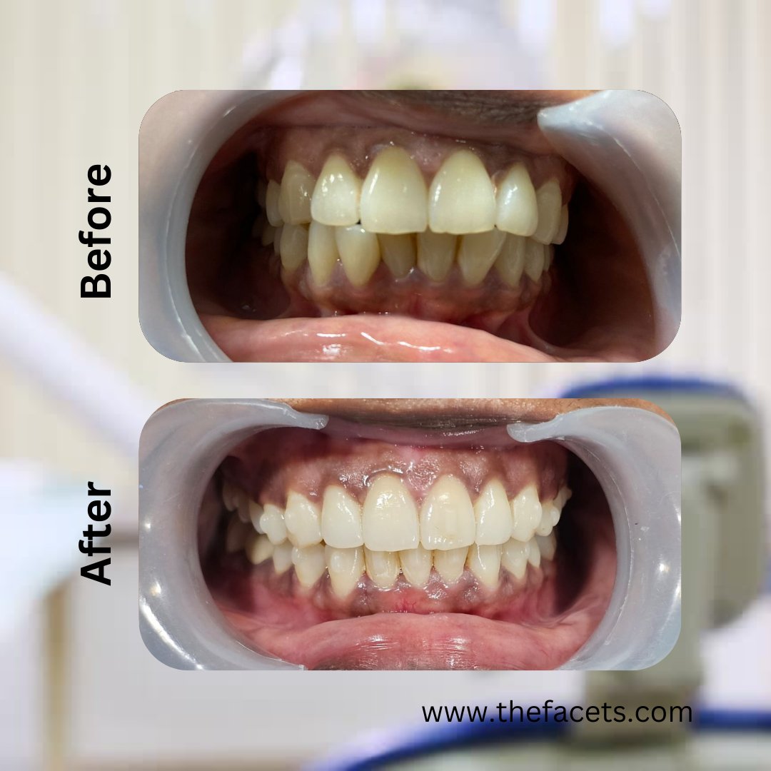 🌟Patient Testimonial: A Radiant Smile Courtesy of Facets Cosmetic  Dental Clinic, Kochi, Kerala🌟

A radiant smile transformation from Facets Restorative and Cosmetic Dental Kochi, Kerala with 25 years of trust and Excellence.

Call/Whatsapp: +91 90 20 160 160