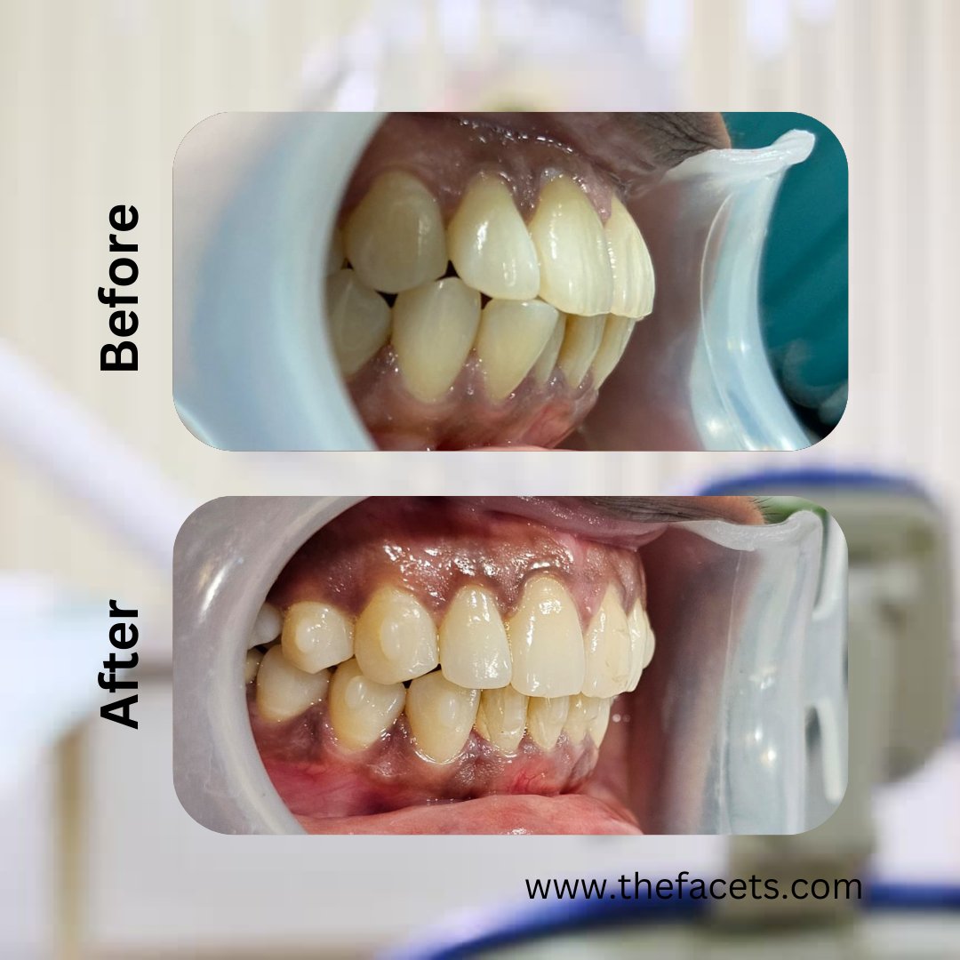 🌟Patient Testimonial: A Radiant Smile Courtesy of Facets Cosmetic  Dental Clinic, Kochi, Kerala🌟 A radiant smile transformation from Facets Restorative and Cosmetic Dental Kochi, Kerala with 25 years of trust and Excellence.

Call/Whatsapp: +91 90 20 160 160