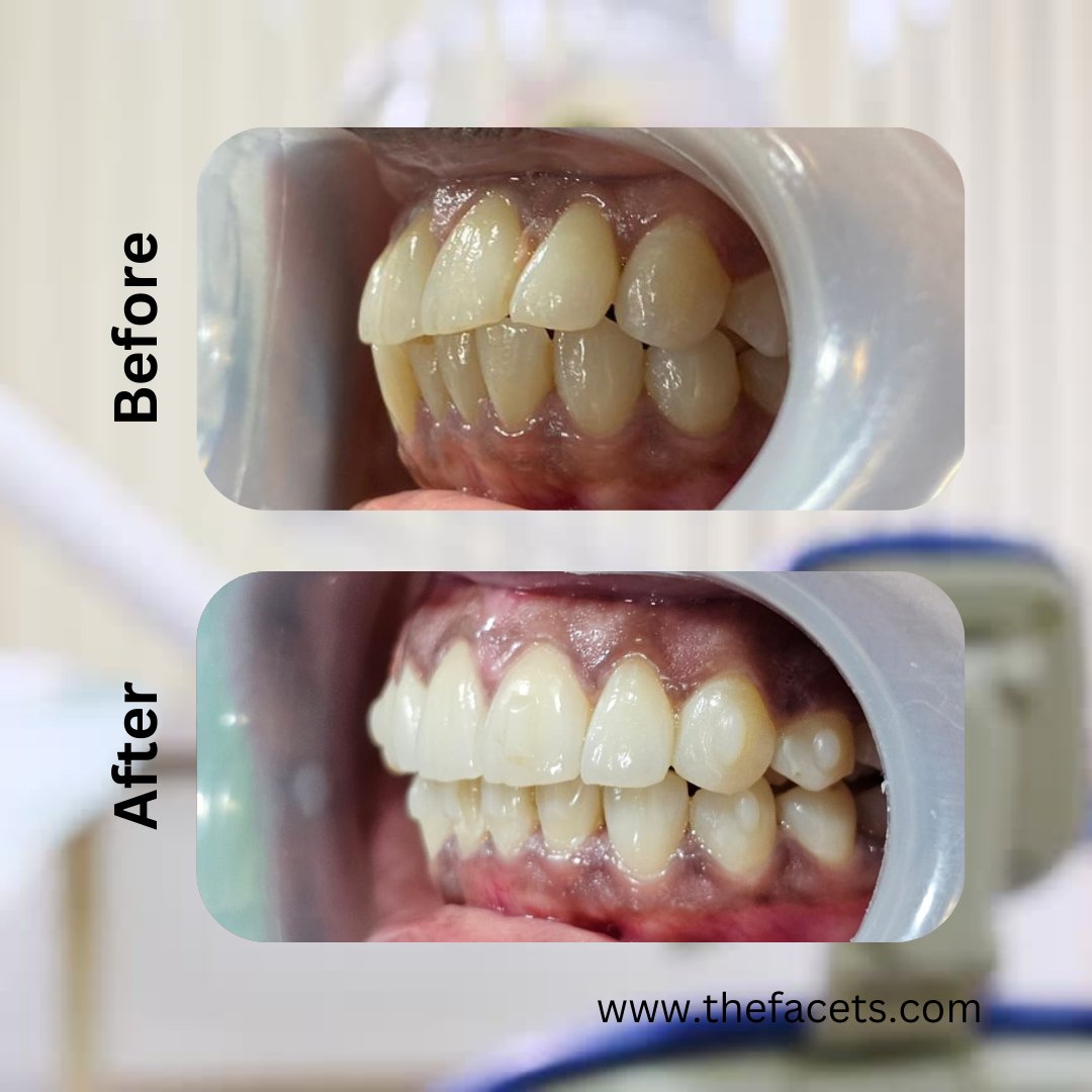 🌟Patient Testimonial: A Radiant Smile Courtesy of Facets Cosmetic  Dental Clinic, Kochi, Kerala🌟 A radiant smile transformation from Facets Restorative and Cosmetic Dental Kochi, Kerala with 25 years of trust and Excellence.

Call/Whatsapp: +91 90 20 160 160