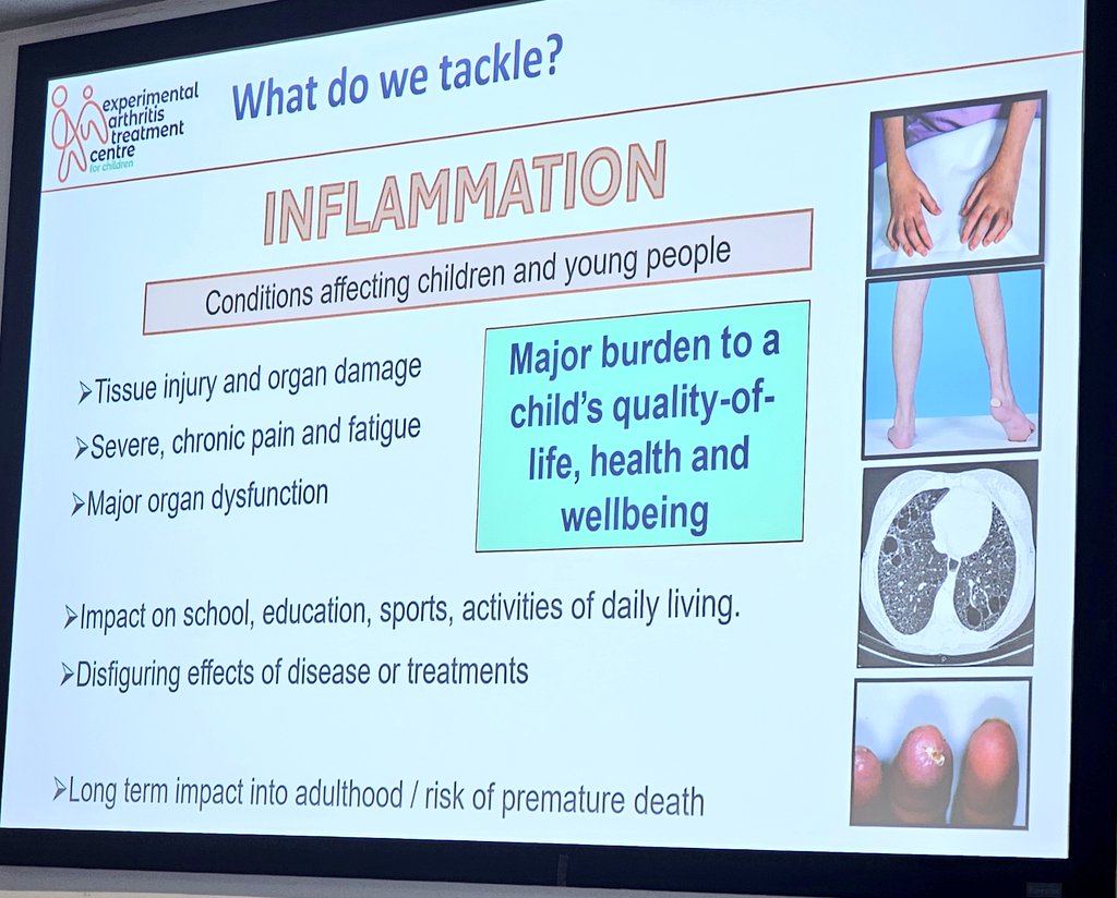 Deborah Alsina (also on Blue Sky) (@deborahalsina) on Twitter photo Michael Beresford explains how inflammation is a driving force of many inflammatory autoimmune conditions such Juvenile Idiopathic arthritis & the huge impact it can have on young people's lives.
Supporting research to help change this remains a priority for us <a href="/VersusArthritis/">Versus Arthritis</a> Michael Beresford explains how inflammation is a driving force of many inflammatory autoimmune conditions such Juvenile Idiopathic arthritis & the huge impact it can have on young people's lives.
Supporting research to help change this remains a priority for us <a href="/VersusArthritis/">Versus Arthritis</a>