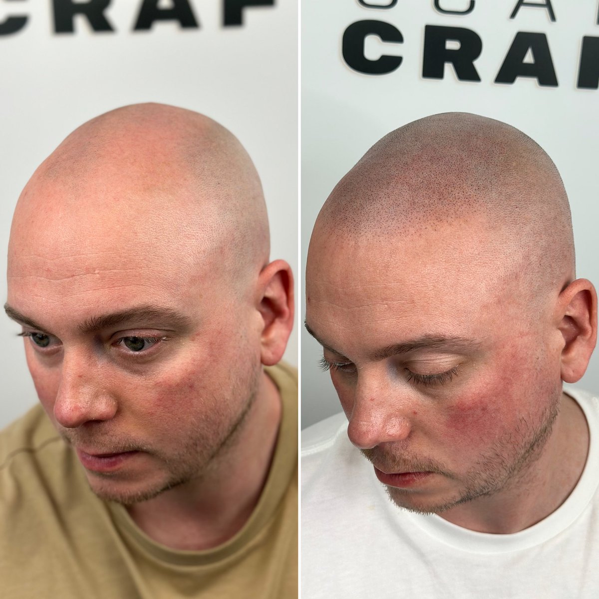 This is a Scalpcraft® hair tattoo (SMP) - we apply thousands of tiny dots to the scalp with a micro needle and pigment, creating the illusion of a hairline and giving the look of a full shaved head of hair. 

☎️ 07300 845 866
🖥️ scalpcraft.co.uk
★ ★ ★ ★ ★ Reviews