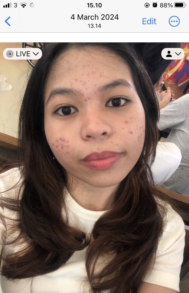 alippyouu's tweet image. Fiya’s acne journey 

March 2024      vs     March 2025