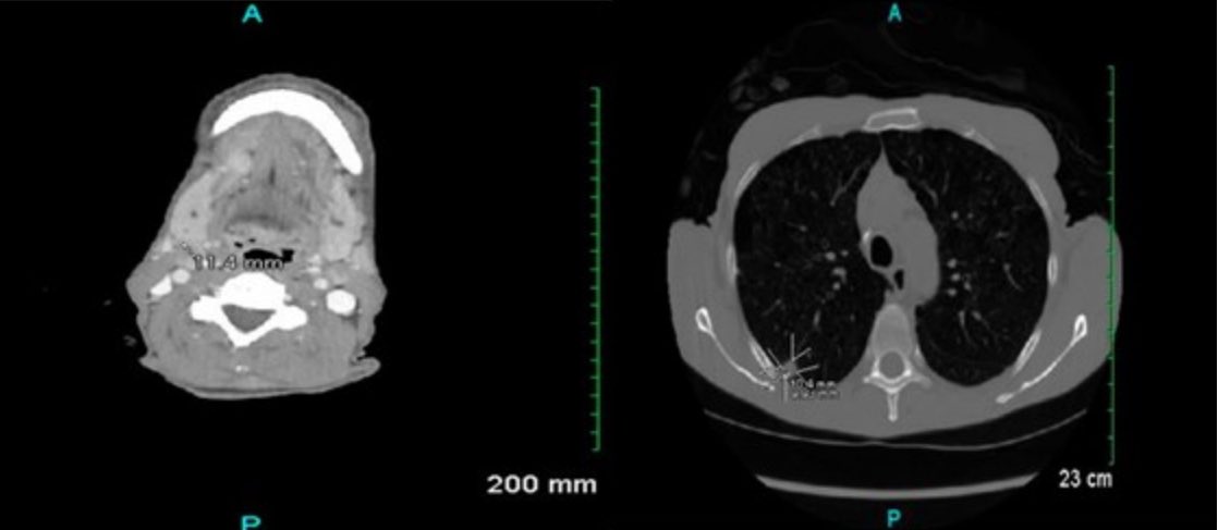 #IDx
73 yo man p/w chronic oral lesions, odynophagia, mildly enlarged cervical LAD, 20 lb weight loss and RUL nodule.  What is the diagnosis and how did he do? *Click to find out*

ppidjournal.com/doi10-55636-pp…