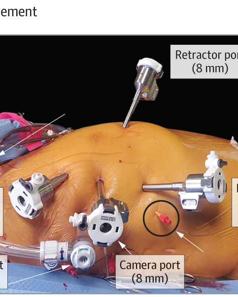 “Total Endoscopic Robotic Mitral Valve Repair Surgery” JAMA Surgery  jamanetwork.com/journals/jamas…