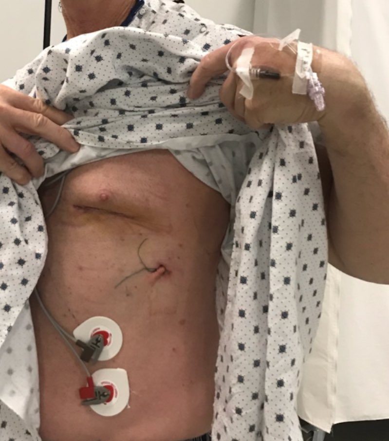FaisalBakaeen's tweet photo. Five High-Impact CABG Presentations &amp; Discussions @AATSHQ #AATS2025:
1- LBCT: MIST-minimally invasive vs sternotomy CABG
2- AI reading coronary angios 
3- All-arterial CABG for all
4- High-risk CABGs that no one wants to do
5- Can “VESTing” veins make them as good as arteries? https://t.co/YLOAkzznZa