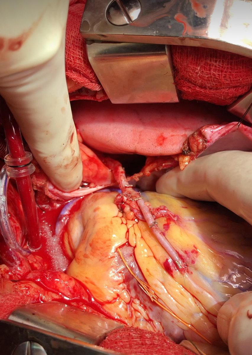 FaisalBakaeen's tweet photo. Five High-Impact CABG Presentations &amp; Discussions @AATSHQ #AATS2025:
1- LBCT: MIST-minimally invasive vs sternotomy CABG
2- AI reading coronary angios 
3- All-arterial CABG for all
4- High-risk CABGs that no one wants to do
5- Can “VESTing” veins make them as good as arteries? https://t.co/YLOAkzznZa